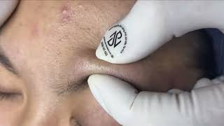 Relax EveryDay With Nhat Bang Spa 2024 Blackheads Removal On Teen [upl. by Mufi]