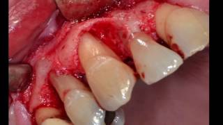 Periodontal surgery Kuljeet MEHTAPeriodontist [upl. by Keil]