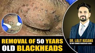 REMOVAL OF 50 YEARS OLD BLACKHEADS II Dr Lalit Kasanas [upl. by Fedora953]