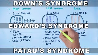 Trisomy  Downs vs Edwards vs Pataus Syndrome [upl. by Alayne]