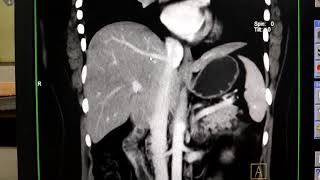 triple phase of Ct scan liver  Radiographer Guruji [upl. by Sorce901]