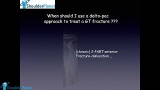 GREATER TUBEROSITY FRACTURES FROM ACUTE TO CHRONIC  MY WAY OF TREATMENT  TRANSOSSEOUS SUTURES [upl. by Namzed915]