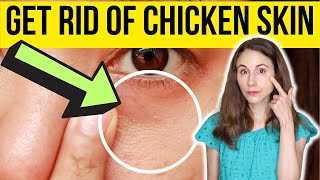 HOW TO GET RID OF CHICKEN SKIN UNDER EYES  Dermatologist [upl. by Issi598]