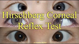 Hirschberg Corneal Reflex Test Principles and Procedure [upl. by Letnuahc]