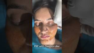 Dermaroller and PRP treatment for acne scar and Collagen Boost at Skinaa Clinic shorts viral [upl. by Atteloiv]