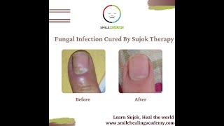 Fungal Infection of Nail Cured By Sujok Therapy [upl. by Anilave]