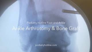 Ankle Arthrotomy and Bone Graft  Podiatry Hotline Foot and Ankle [upl. by Balas]