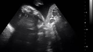 interesting case 467 ultrasound 2D 3D 4D acardiac twin [upl. by Scandura]