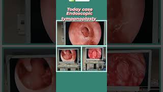 13 November 2024 Large EAR 👂 DRUM perforation repairtympanoplastyendoscopic ear 👂 surgery [upl. by Persian]