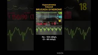 Brugada Syndrome  Hyponatremia Induced [upl. by Ribaudo]