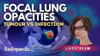 Focal lung opacities tumour vs infection with​ Miranda Siemienowicz [upl. by Ayeki]