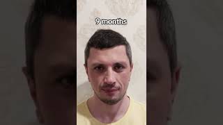 Hair Transplant Result  Hair Transplant Time lapse  Hair Transplant in Turkey [upl. by Dwayne448]