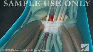 Carpal Tunnel Syndrome and Release [upl. by Ilesara834]