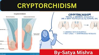 Cryptorchidism  Nursing Classes  Pediatric Nursing  Easy Explanation in Hindi [upl. by Hsak20]