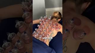 Cupping Therapy Explanation [upl. by Nicolea]