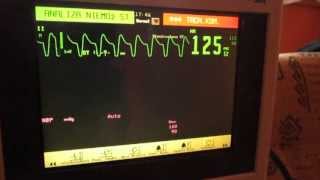 EKG Monitor [upl. by Pardoes]