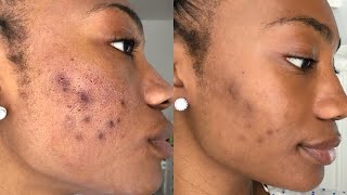 CLEARING UP ACNE SCARRING amp HYPERPIGMENTATION [upl. by Enilarak]