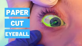 Paper Cut on Eyeball  Viewer Discrection [upl. by Nave]