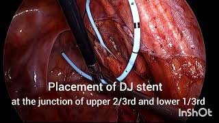 LAPAROSCOPIC URETEROLITHOTOMY FOR LOWER URETERIC STONE [upl. by Manning715]