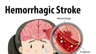 Hemorrhage Stroke Brain Hemorrhage [upl. by Ainoloppa]