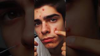 Why do we get pimples on our face telugu facts health knowledge factstelugu viral viralshorts [upl. by Rosalee717]