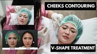 Thread Lift Before and After Tanam Benang Wajah  Ovela Clinic Indonesia [upl. by Sikata]