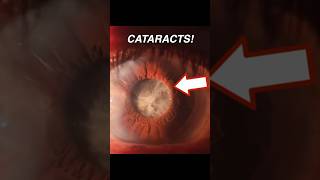 Doctor Explains How CATARACTS Form 👁️☁️ [upl. by Ominoreg323]