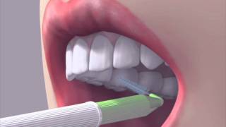 How to use an interdental brush [upl. by Erialc609]