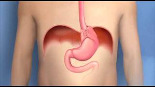 Antireflux Surgery FundoplicationMayo Clinic [upl. by Haisi]