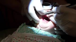 Lasers and infant teathered oral tissues tongue and lip ties [upl. by Ycnalc939]