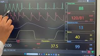 Analyzing Ventricular ECG Rhythms PVC VT runs Ventricular Tachycardia Right BBB Torsades [upl. by Ayar]