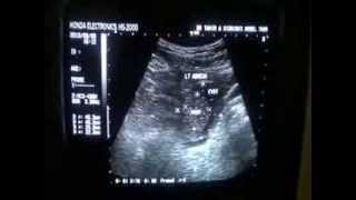 LT OVARIAN CYST with SOLID fixed area in it [upl. by Estevan]