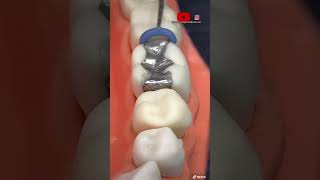 ¡🔥Instalación de separadores dentales y bandas metálicas en las muelas 0🦷0🔥 [upl. by Ecirp793]