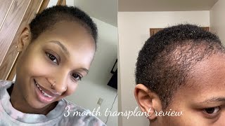 3 Month hair transplant review  WOULD I GO BACK TO LONGEVITA [upl. by Godbeare]