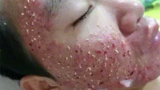 Big Cystic Acne Blackheads Extraction Blackheads amp Milia Whiteheads Removal Pimple Popping  2662 [upl. by Ekralc]