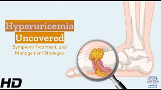 Hyperuricemia Understanding Its Signs Effects amp Management Essentials [upl. by Templer]