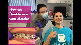 How to Double over your elastics  Clearly Orthodontics [upl. by Jeanna]