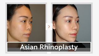 Asian Rib Cartilage Rhinoplasty  VIP Plastic Surgery Center Seoul Korea [upl. by Nesral]