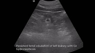 CASE 998 Persistent fetal lobulation of left kidney with GI hydronephrosis [upl. by Lleon]