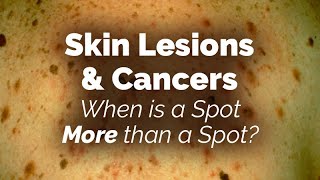 When is a Spot More than a Spot Skin Lesions and Cancers [upl. by Eenobe78]