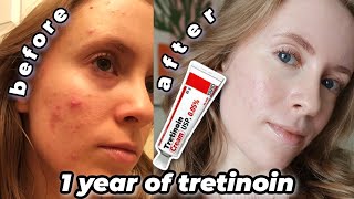 1 YEAR TRETINOIN UPDATE Before amp After  My Current Skincare Routine tretinoin cream 005 [upl. by Thorlay245]