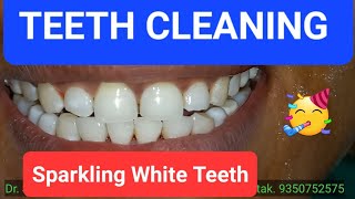 Teeth cleaningtartar removalscaling How teeth cleaning is done दांतों की सफाई कैसे होती है [upl. by Ahsercel]