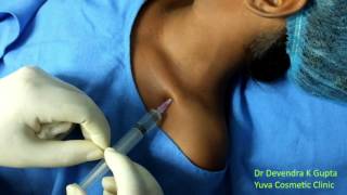 Devendras Infraclavicular Pediatric Brachial block [upl. by Ialda]