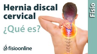 Hernia discal cervical  Qué es y cuáles son sus causas [upl. by Haidebez161]