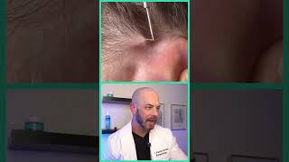 Derm reacts to MASSIVE ingrown hair dermreacts doctorreacts ingrownhair [upl. by Olnek]