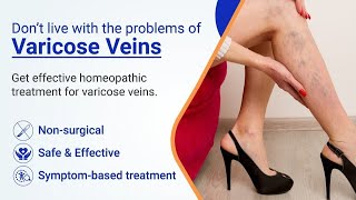 Vericose Veins Treatment  Scelero Therapy vericose veins yt treanding viralvideo [upl. by Parrnell]