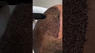 First Hair Wash After Hair Transplant Expert Tips  Dadu Medical Centre [upl. by Isdnyl]