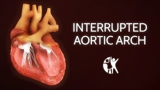 Interrupted Aortic Arch − Ventricular Septic Defect [upl. by Dion932]