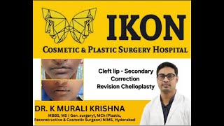 Cleft lip  secondary Correction [upl. by Karol]