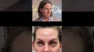 Plastic Surgeons React to Eyelid Surgery Gone Wrong [upl. by Evetta]